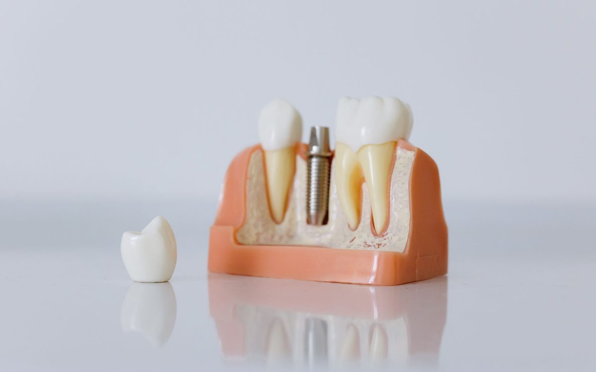 que son los implantes dentales