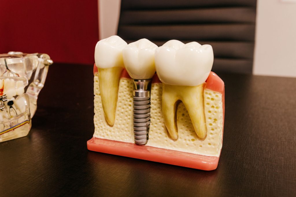 tipos de implantes dentales